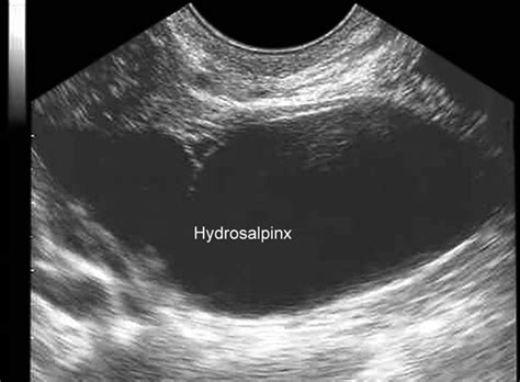 Understanding Hydrosalpinx: Causes, Symptoms, and Treatment Options ...