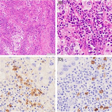 Photomicrographs Of Pulmonary Adenocarcinoma Metastasizing Into The Download Scientific Diagram