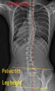 Scoliosis Exercises Posture Direct