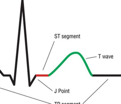 Basic Arrhythmia Course Flashcards Quizlet