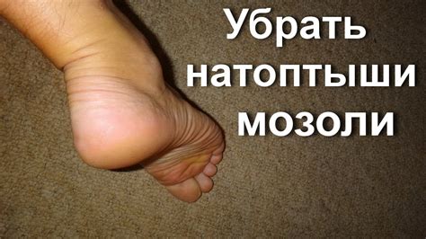 Мозоли на ногах: лечение сухих мозолей, мозолей со стержнем, мокрых ...