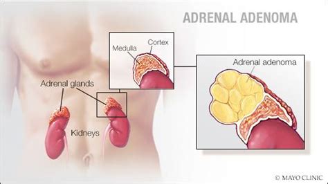 Mayo Clinic Q And A Understanding Adrenal Adenoma Mayo Clinic News Network