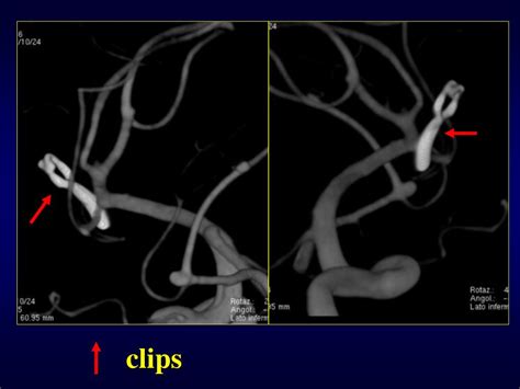 Ppt Cerebral Aneurysms Powerpoint Presentation Free Download Id 154737