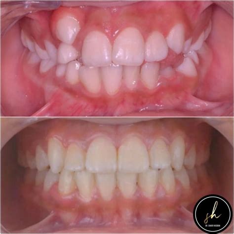 Dr Samer Hassoun On Linkedin Upper Lateral Incisors Are Amongst The Most Frequent Teeth To