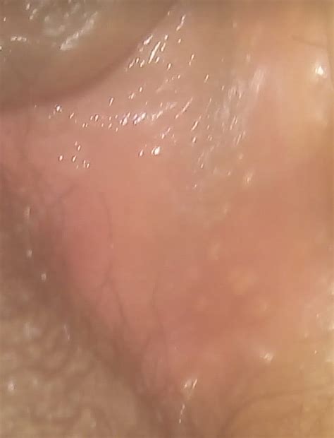 Granos En La Entrada De La Vagina Resuelto