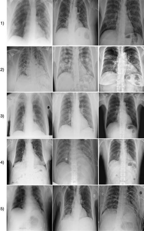 COVID Net A Tailored Deep Convolutional Neural Network Design For