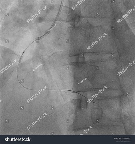 41 Cardiac Stent Placement Images, Stock Photos & Vectors | Shutterstock