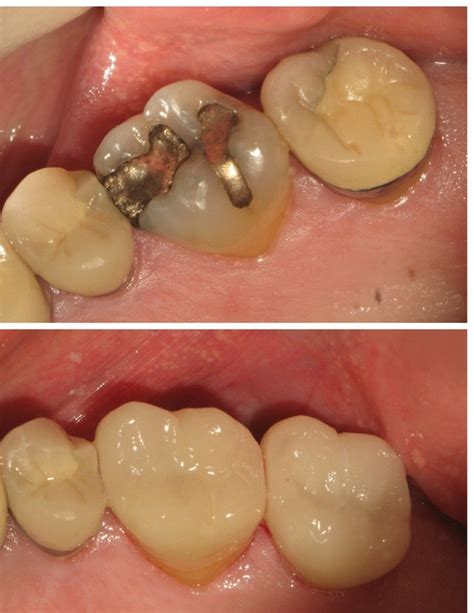 Replace Your Amalgam Or Gold Fillings With White Composite Fillings