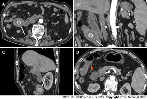 Endoscopic And Surgical Treatment Of Jejunal Gallstone Ileus Caused By