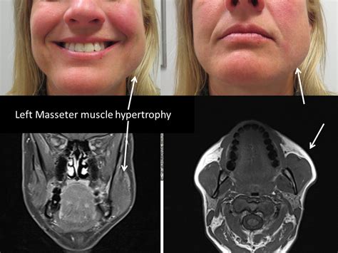 Masseter Hypertrophy Facial Swelling Botulinum Toxin Treatment Iowa Head And Neck Protocols