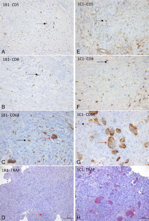 Characterization Of Cells Present In Cherubism Granulomas CD5 CD8