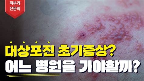 대상포진 증상 치료 통증 흉터 치료 5️⃣분 안에 해결해드립니다 Youtube