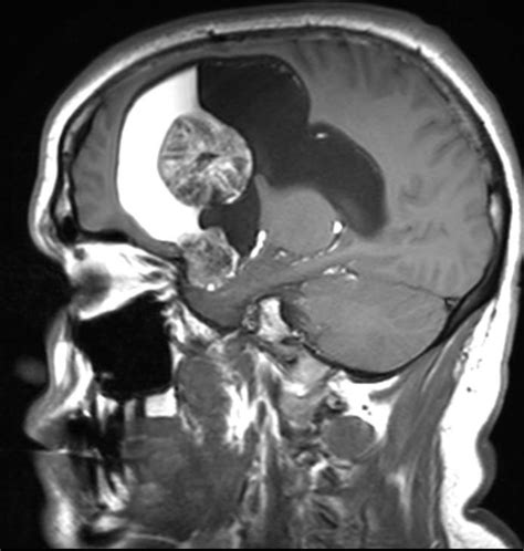 Ruptured Intraventricular Dermoid Cyst R Radiology