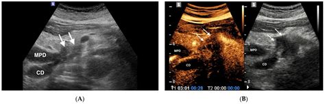 Focal Pancreatic Lesions Role Of Contrast Enhanced Ultrasonography