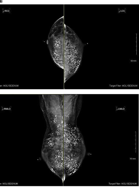 Figure 1 From Breast Involvement In Mixed Connective Tissue Disease Semantic Scholar