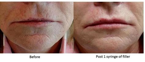 Botox On Smokers Lines Before And After Photos 5 Facial Injections