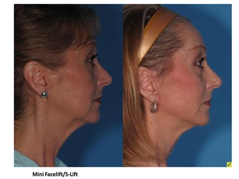 Mini Facelift S Lift Before After Photos Summit Plastic Surgery