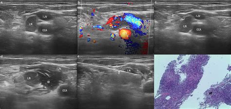 Frontiers Comparison Of Ultrasound Guided Core Needle Biopsy Under The Assistance Of