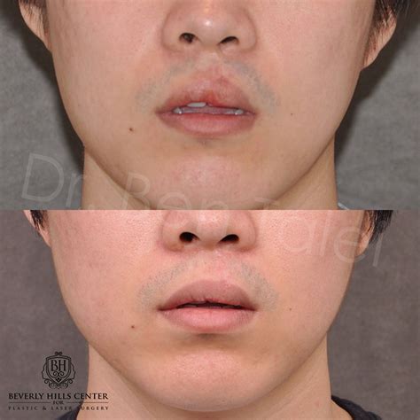 Scars On Lips Treatment Lipstutorial Org