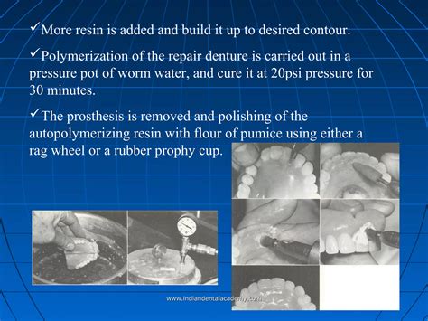 Repair Of Complete Dentures Oral Surgery Courses Ppt