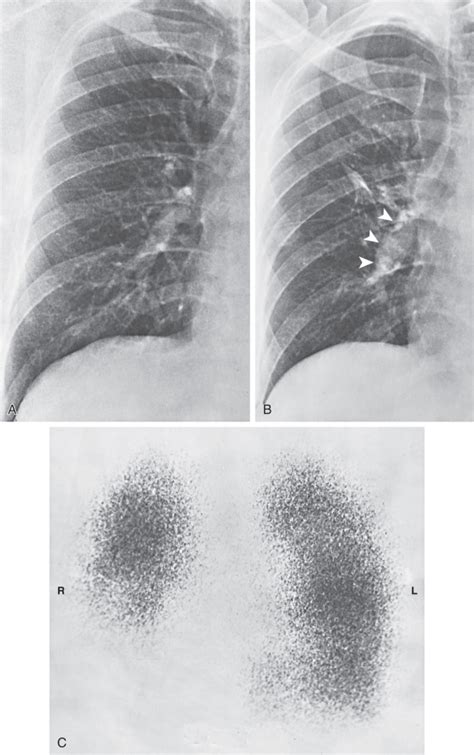 Acute Pulmonary Embolism Radiology Key