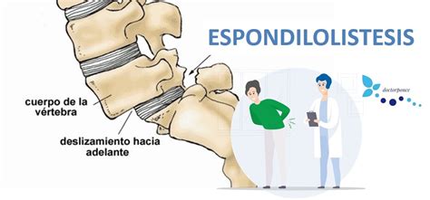 Espondilolistesis Cl Nica Reumatol Gica Doctor Ponce