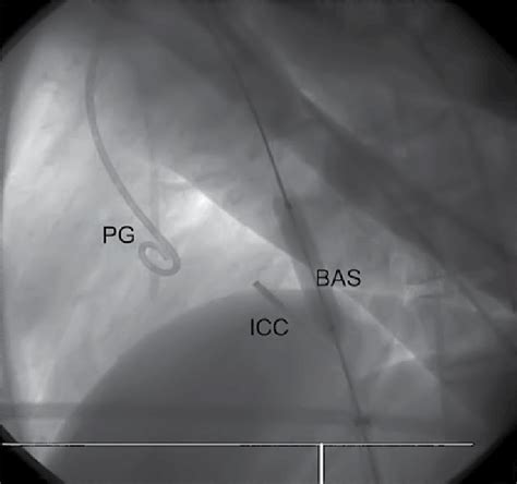 90 Left Oblique View During Balloon Atrial Septostomy Pg Pigtail