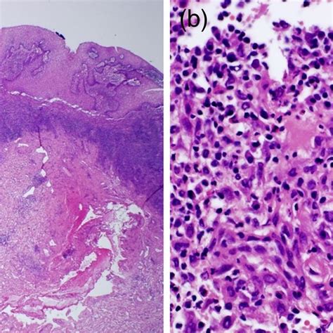 A Histopathologic Examination Exhibited Chronic Suppurative And Download Scientific Diagram