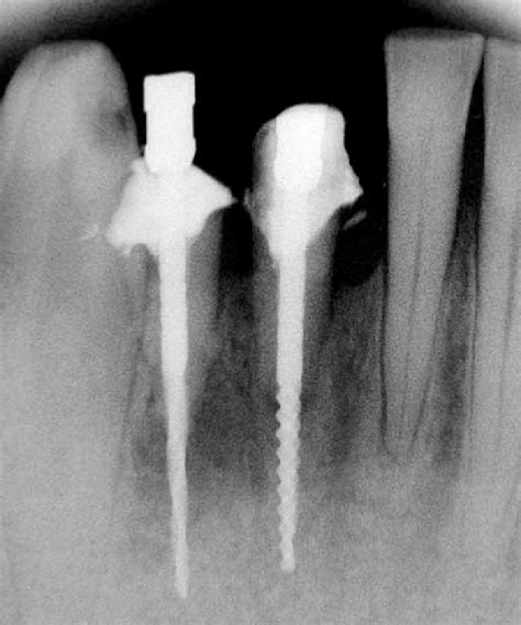 Radiografia Periapical P S Operat Ria Observe Os Implantes