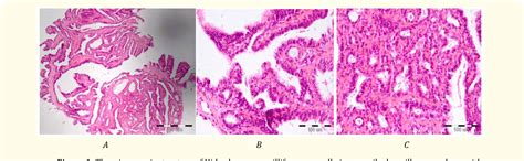 Figure 1 From Hidradenoma Papilliferum Of The Vulva Presenting As A