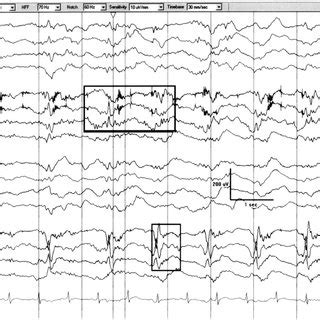 Fluctuating Lpds Lateralized Periodic Discharges That Fluctuate In