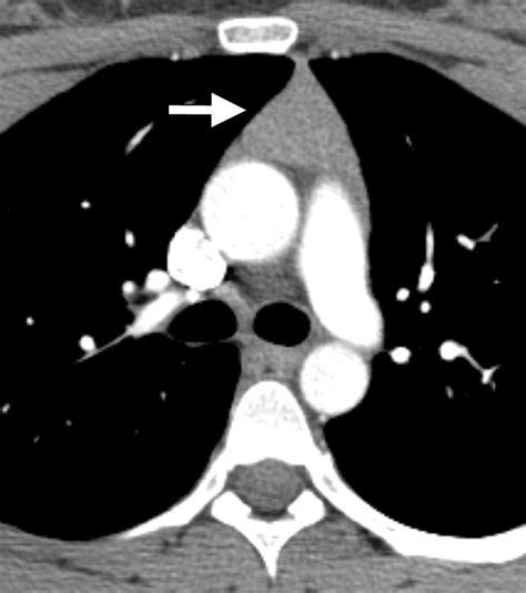 Role Of Imaging In The Diagnosis Staging And Treatment Of Thymoma