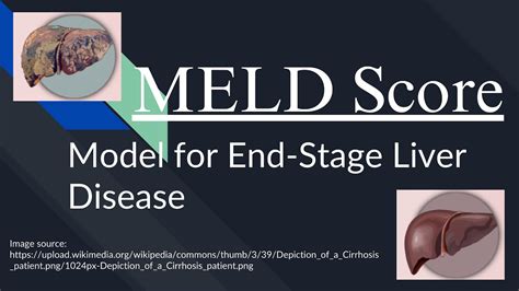 Meld Score The Model For End Stage Liver Disease How To Calculate And Interpret Meld Score