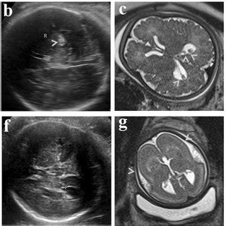 Prenatal Imaging Of Two Typical Cases P221 Top Row And P796 Bottom