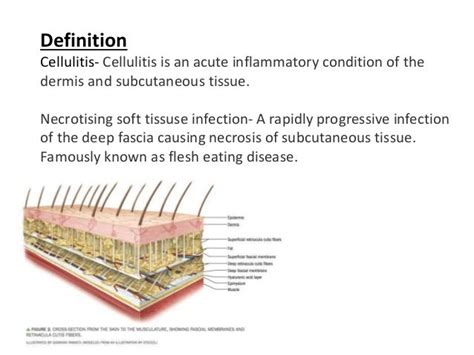 Cellulitis Vs Necrotizing Fasciitis / Cellulitis - Clinical Image and ...