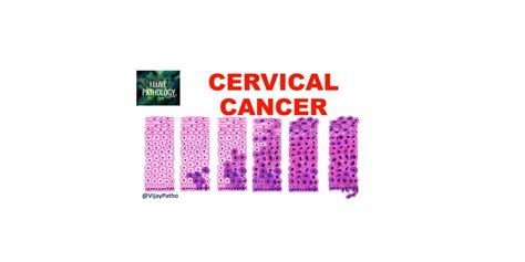 Cervical Intraepithelial Neoplasia And Cervical Cancer Pathology Made