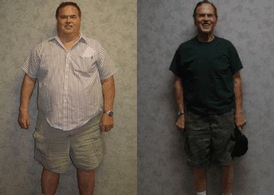 Bariatric Surgery Before And After Pictures In Houston TX Cypress