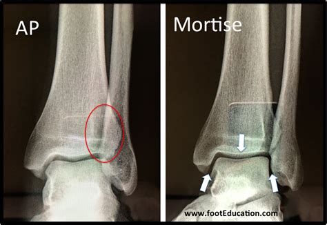 Ankle Fractures Tibia And Fibula Orthopaedia Foot Ankle