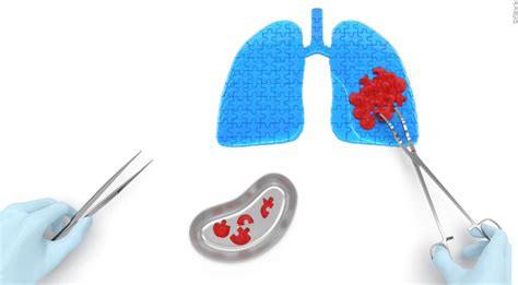 Die Immuntherapie Erobert Die Behandlung Des Nsclc Im Sturm Onkologie Universimed Medizin