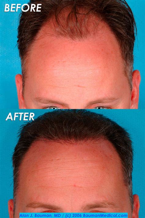 Hair Loss Treatment Center Boca Raton Fl Dr Bauman