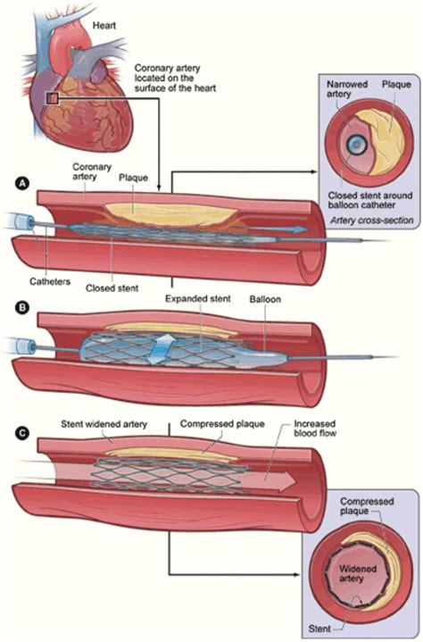 How I Lowered My Cholesterol In 90 Days With No Meds Hubpages