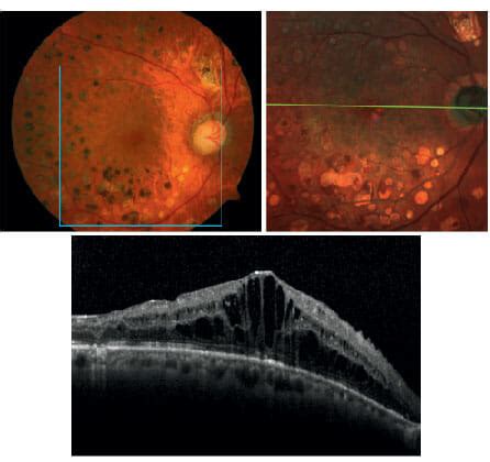 Understanding Myopic Tractional Maculopathy - mivision