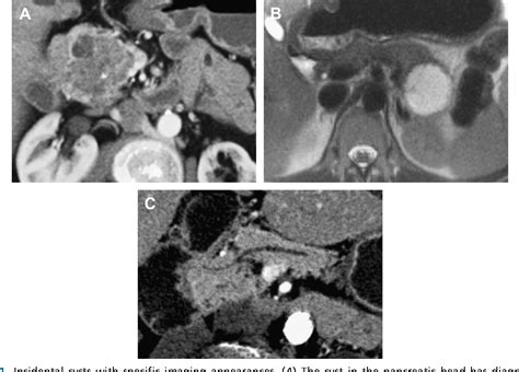 Figure From The Incidental Pancreatic Cyst Semantic Scholar