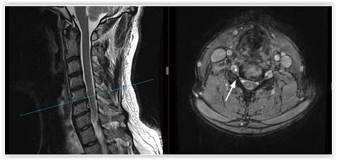 Neural Foramen Mri