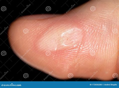 Corn On A Finger Isolated On A Black Stock Photo Image Of Hand Care