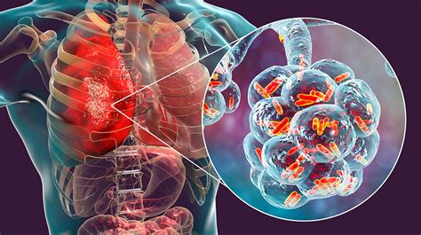 La Tos Es Un Mecanismo De Defensa De Los Pulmones Instituto De