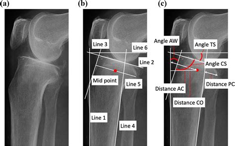 The Posterior Tibial Slope Is Mainly Created By The Posterior Rotation