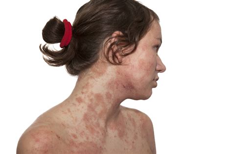 Different Types Of Dermatitis And Eczema