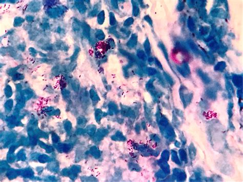 Photomicrograph Showing Several Clusters Of Lepra Bacilli Wade Fite Download Scientific