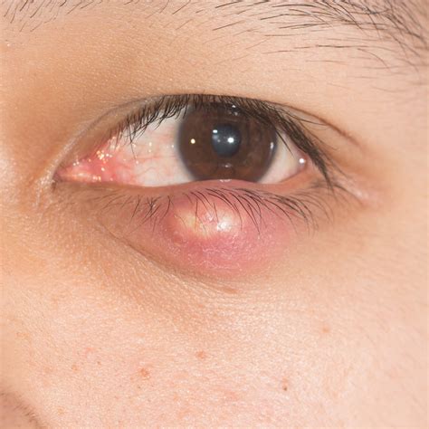 Chalazion Eye Patient